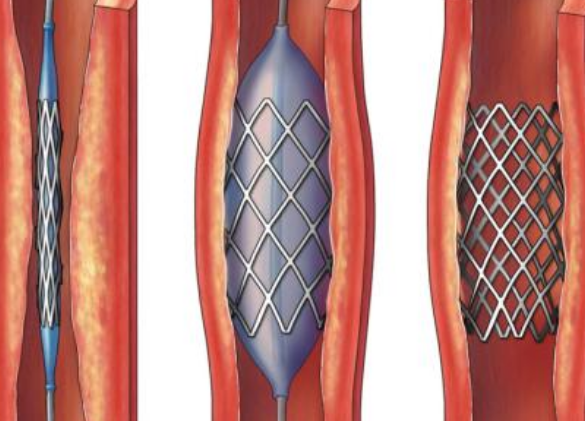 好消息！700元冠脈支架來(lái)了帶量采購(gòu)結(jié)果在甘肅省正式落地執(zhí)行
